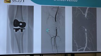 La nuova tecnologia GAE per i pazienti con dolore al ginocchio