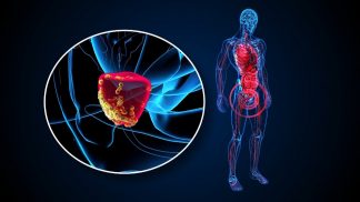 Tumore alla prostata: le novità nel trattamento con radioligandi