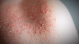 Idrosadenite suppurativa: una novità sul fronte delle cure